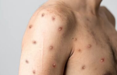 Monkeypox: Dúvidas comuns de consultório