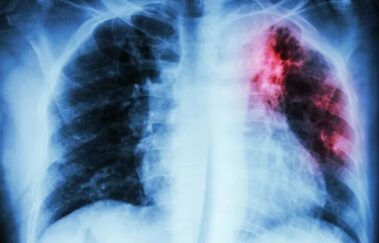 Tuberculose: campanha de busca ativa termina nesta segunda-feira em Jundiaí